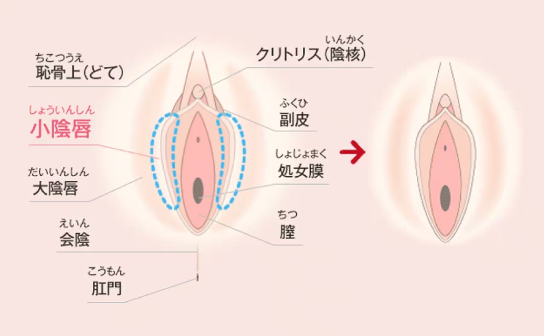 アソコのビラビラを小さくできます